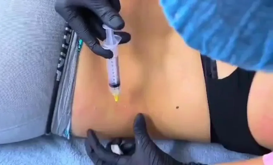 Mesoterapia